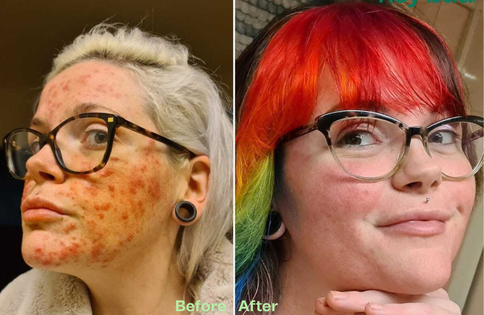 Acne All Stars + FREE Clay Mask