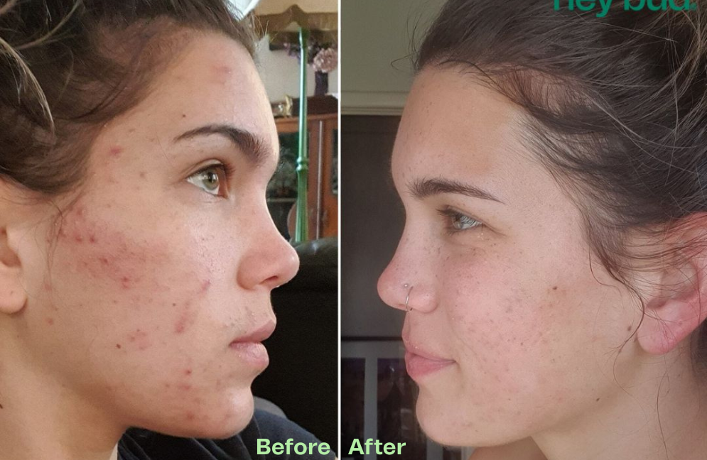 Acne All Stars + FREE Clay Mask