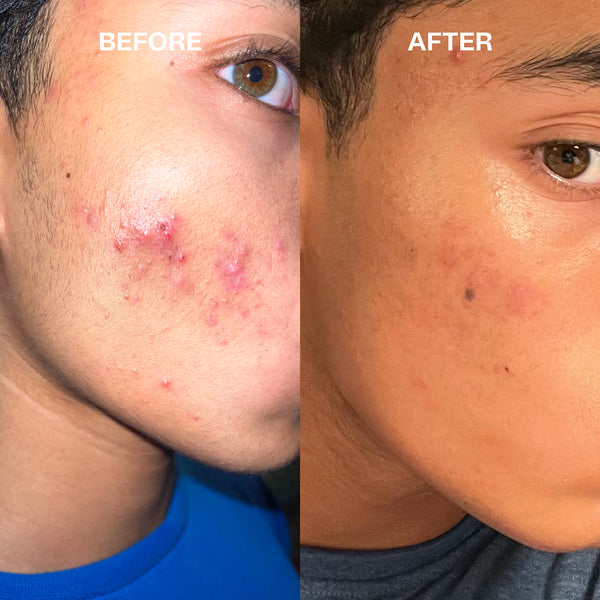 Acne Clearing Treatment - VIP