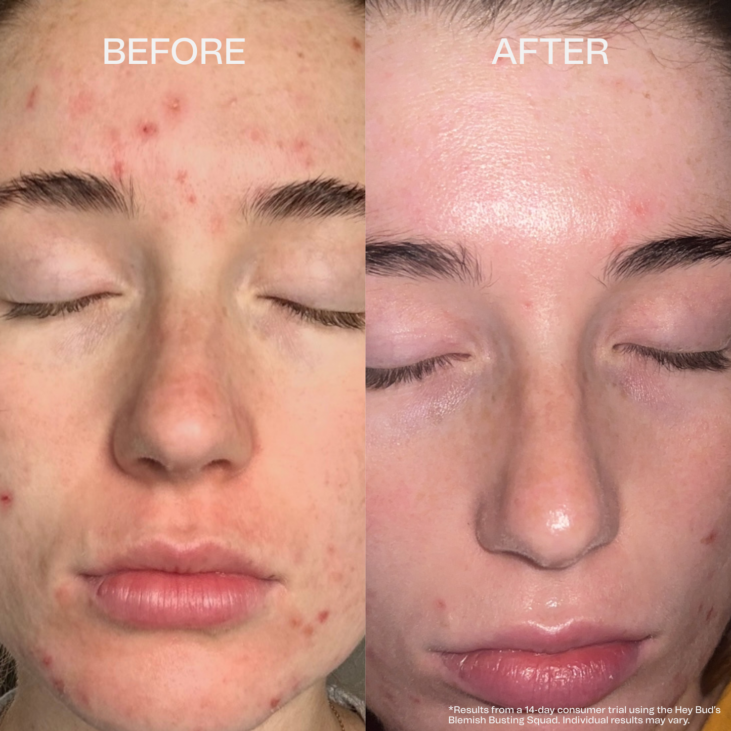 The Blemish Busting Squad