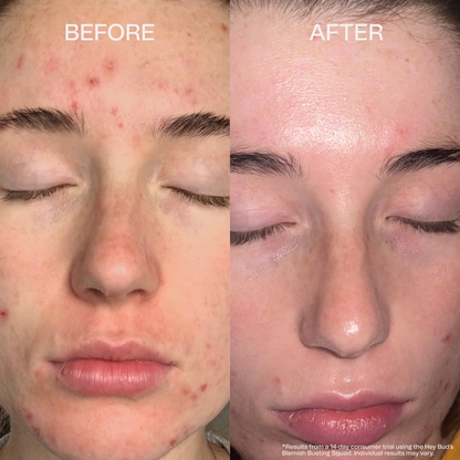 The Blemish Busting Squad