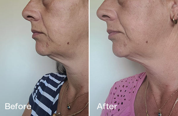 Before and After Kerry P.
